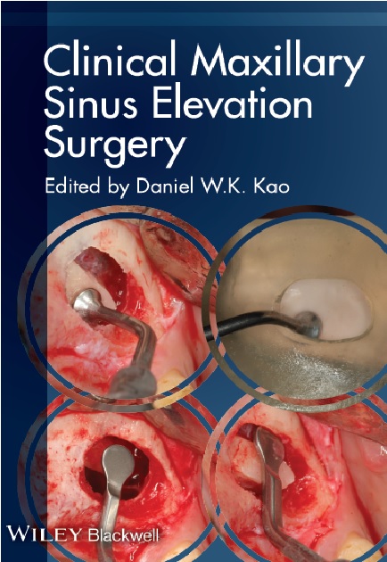 Clinical Maxillary Sinus Elevation Surgery 1st Edition PDF