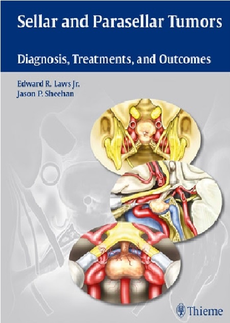 Sellar and Parasellar Tumors: Diagnosis, Treatments, and Outcomes PDF